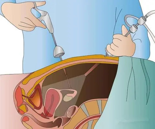 试管婴儿移植后成功着床的反应是什么着床后腹泻有影响吗